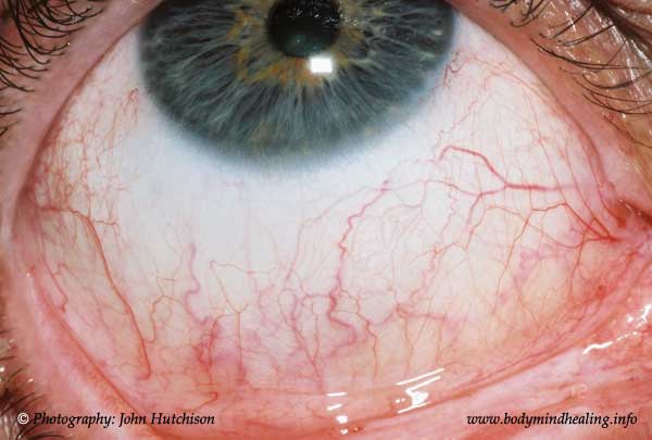 Right Inferior Sclera