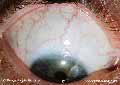 Right Superior Sclera