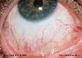 Right Inferior Sclera