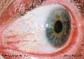 Left Medial Sclera